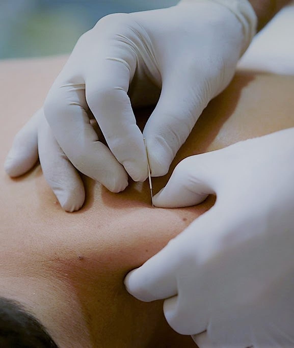 Sesión de punción seca en la consulta de Egia Fisioterapia